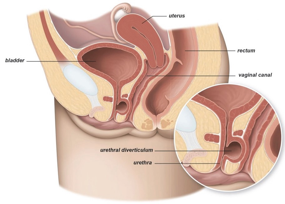 excision-of-urethral-diverticulum-brighton-and-sussex-university